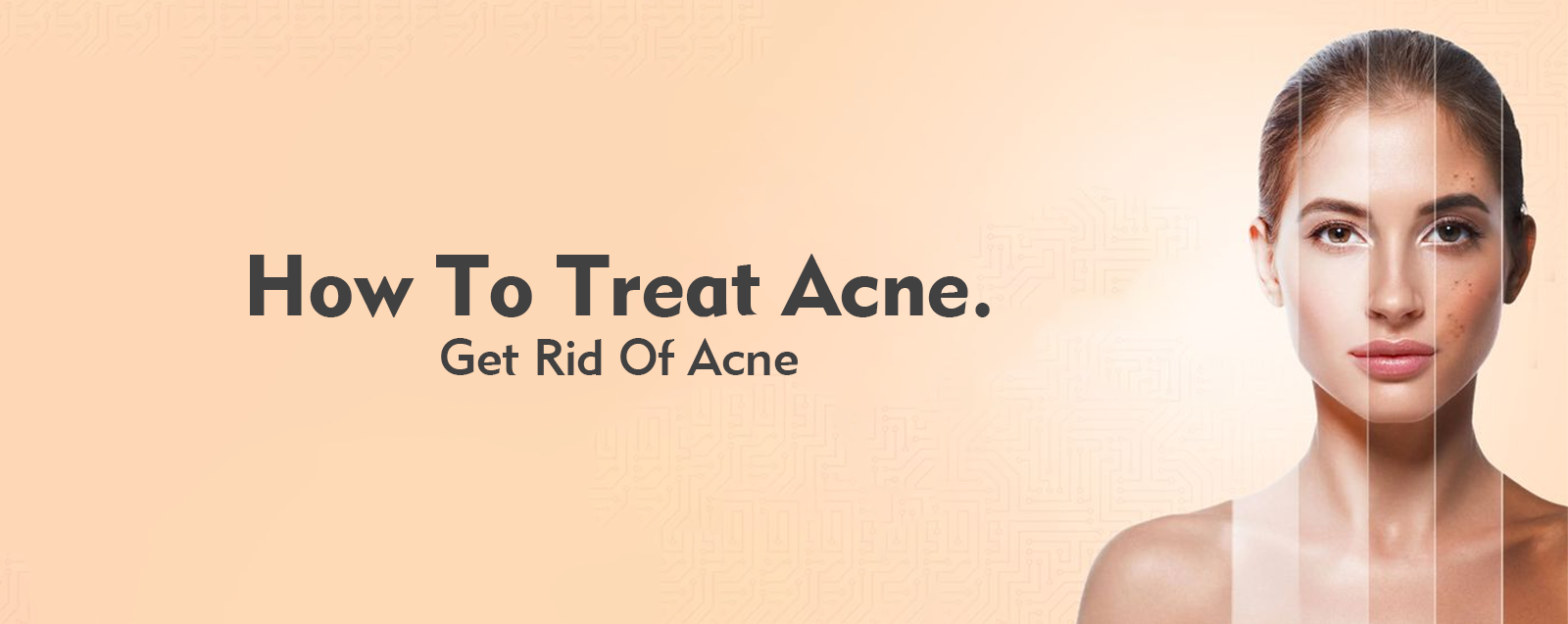 How To Treat Acne – Get Rid Of Acne